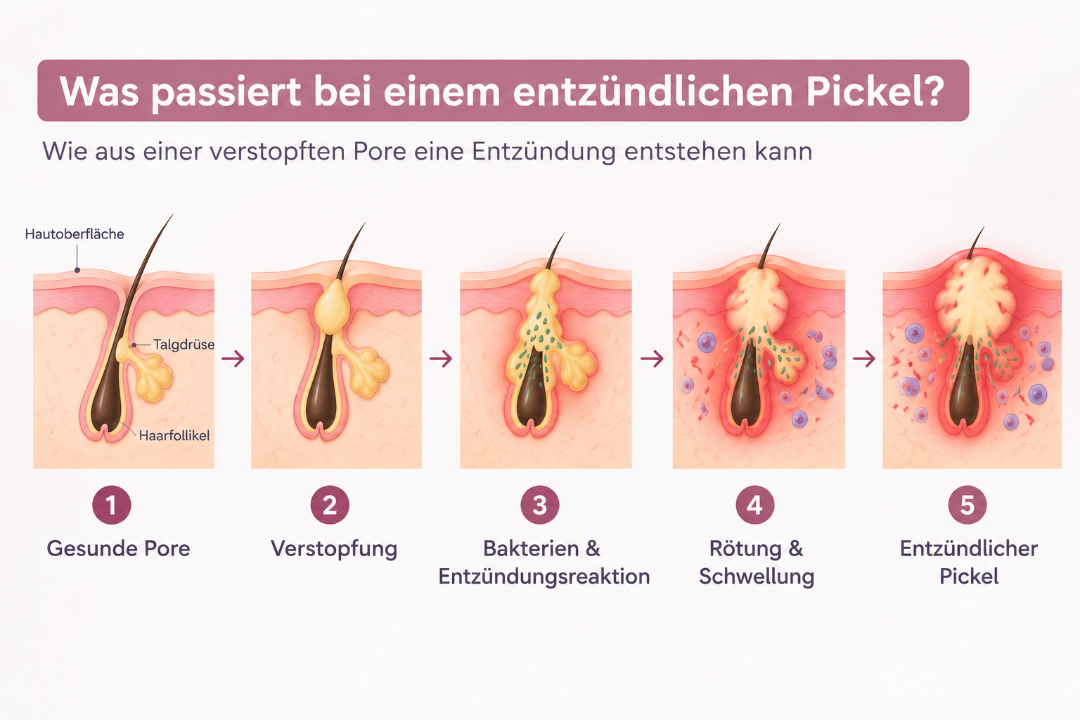 Entzündungen und Akne: Entstehung eines entzündlichen Pickels